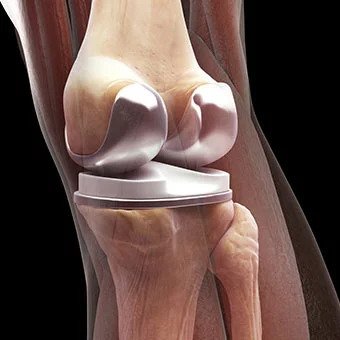 knee replacement surgery in Meerut